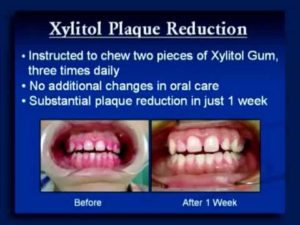 REversing Cavities with Xylitol