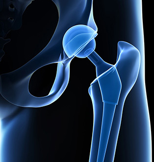 3d rendered illustration of a hip replacement