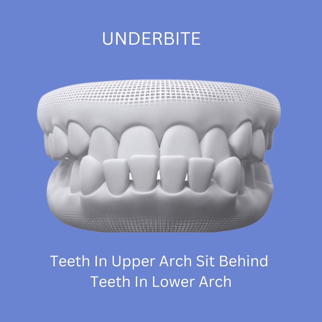 Underbite Image Before Orthodontic Treatment