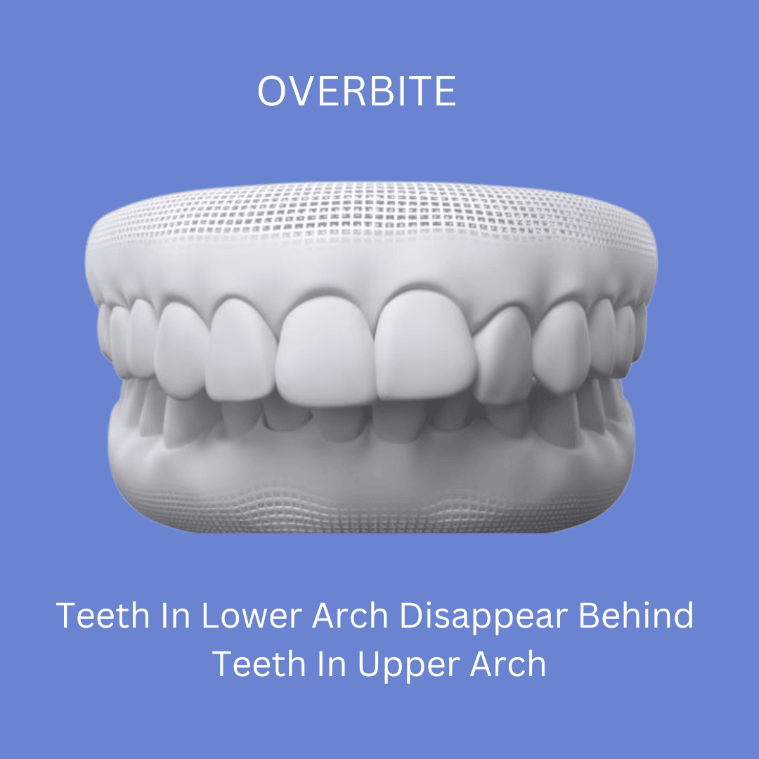 Overbite Image Before Orthodontic Treatment