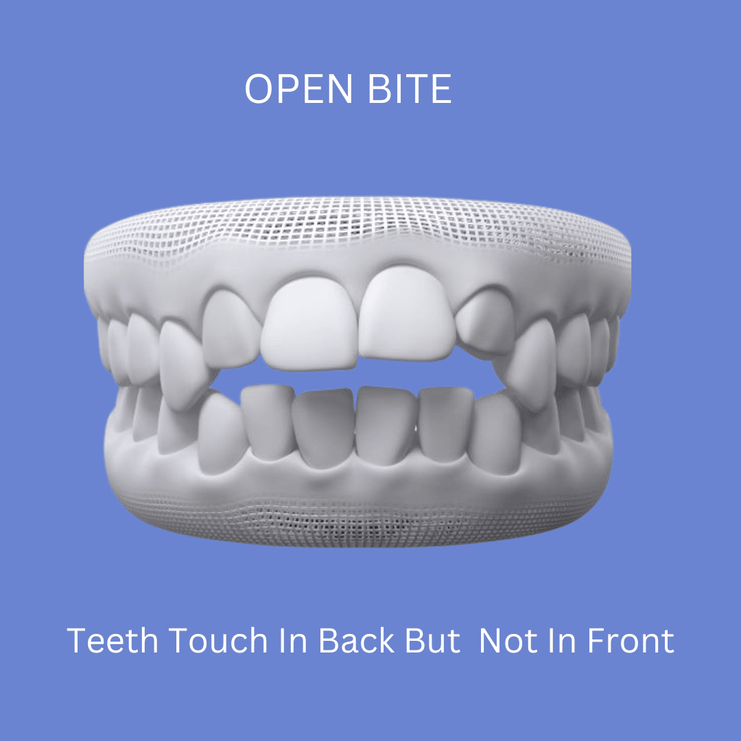 Open Bite Image Before Orthodontic Treatment
