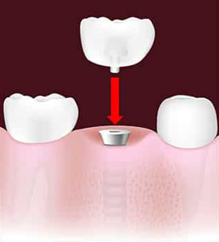 dental-implant_3